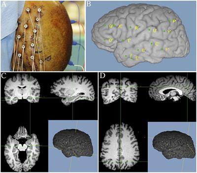 The Role of Associative Cortices and Hippocampus during Movement Perturbations